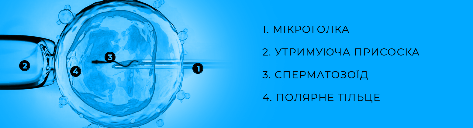 ЕКО при ендометріозі