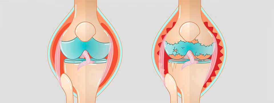 Артроз колінного суглоба (гонартроз)