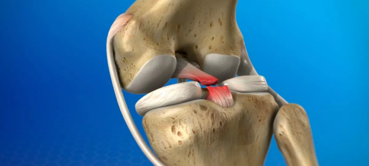 Розрив задньої хрестоподібної зв'язки коліна