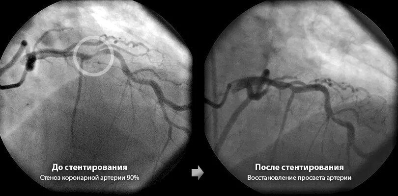 Стентирование сосудов сердца фото