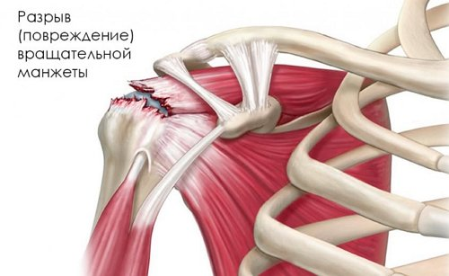 Пошкодження ротаторної манжети
