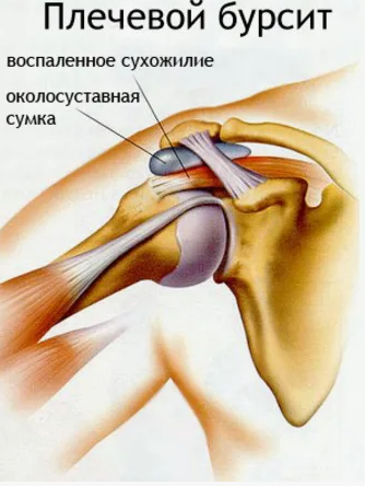 бурсит плечевого сустава
