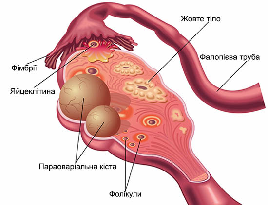 Удаление кисты яичников