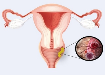 рака влагалища