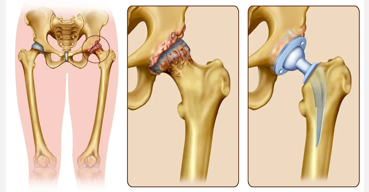 Лечение коксартроза тазобедренного сустава