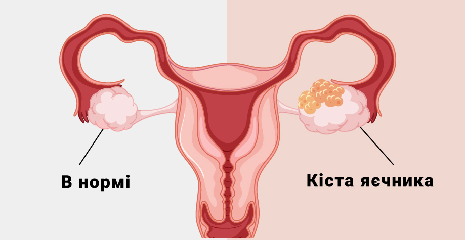 Киста яичников