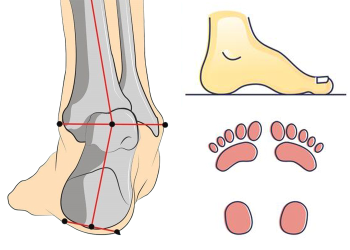 Симптомы вальгусной деформации стопы