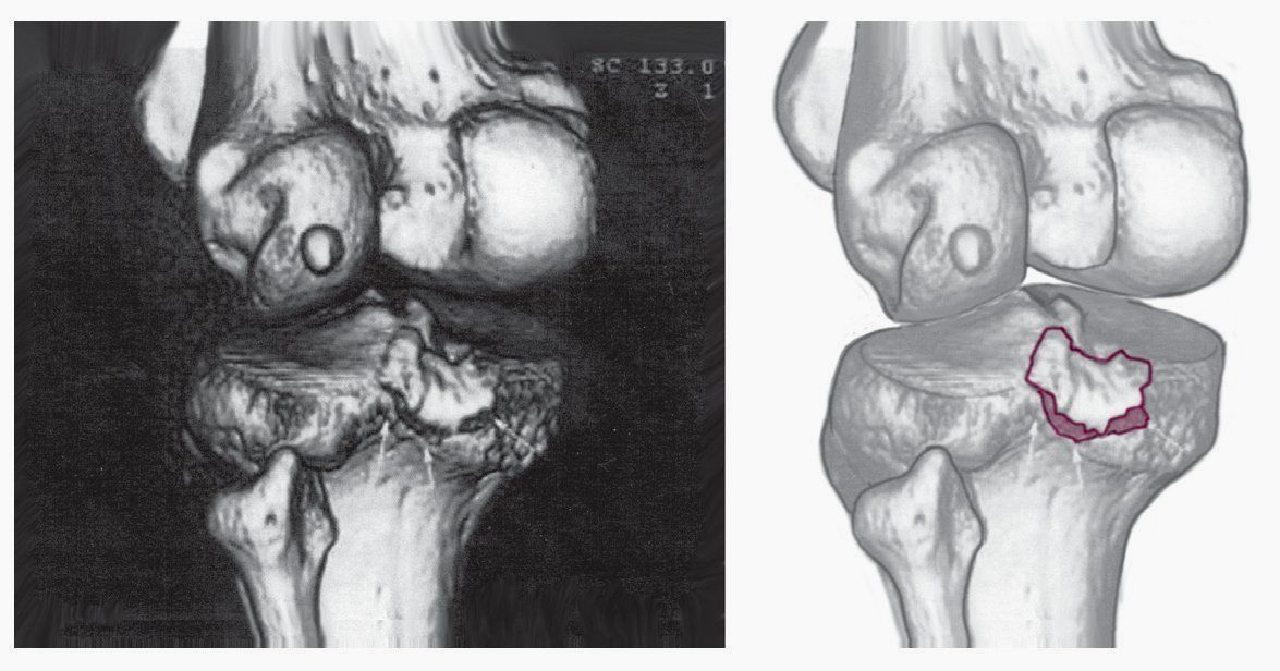 розрив задньої хрестоподібної зв'язки мрт