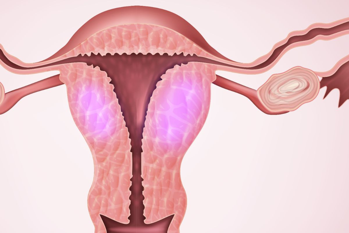 аденомиоз матки