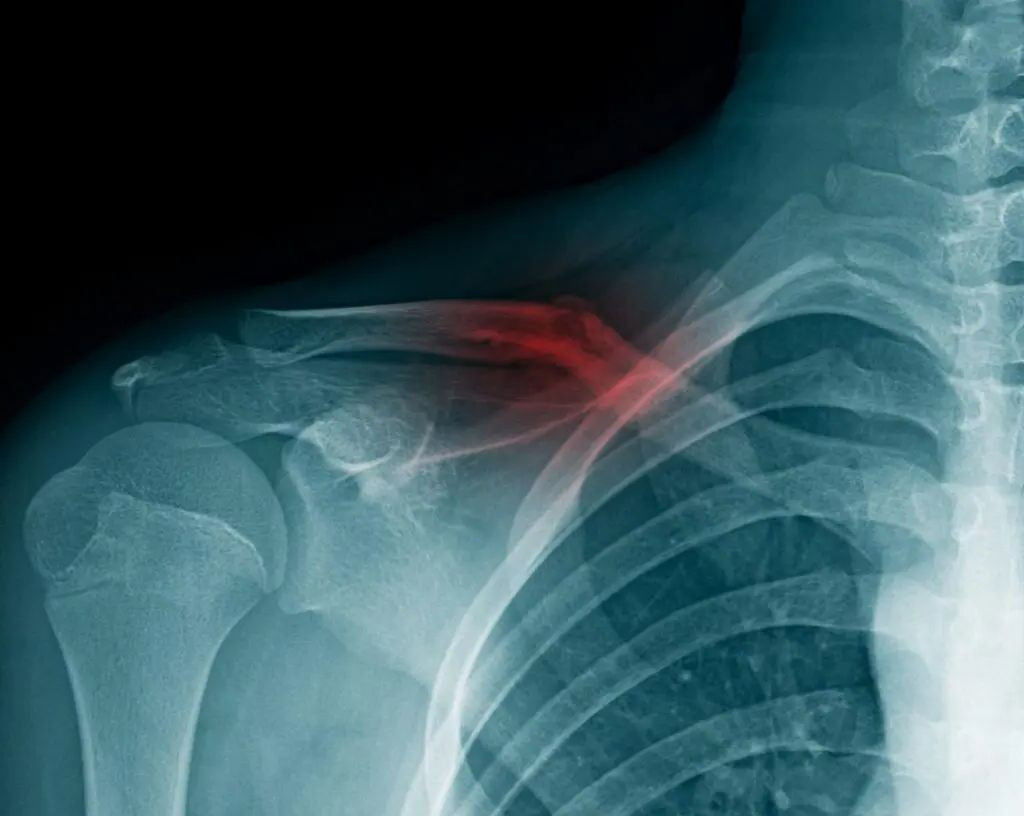 перелом ключицы