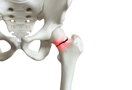 Перелом шийки стегна