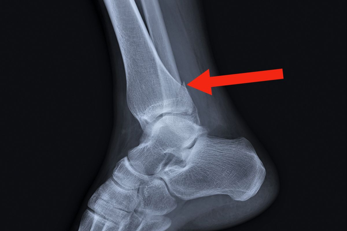 Переломы лодыжки