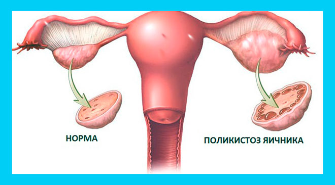 Квалифицированное лечение поликистоза