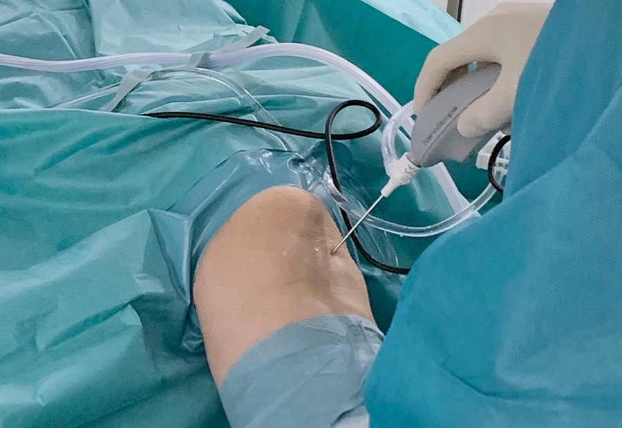 операция на мениске