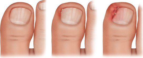 как лечится вросший ноготь