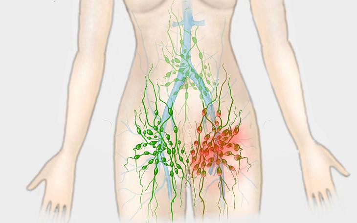 удаление паховых лимфоузлов