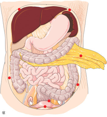 оментэктомия (удаление большого сальника)