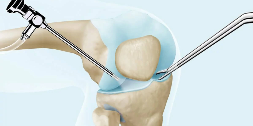 Артроскопия мениска