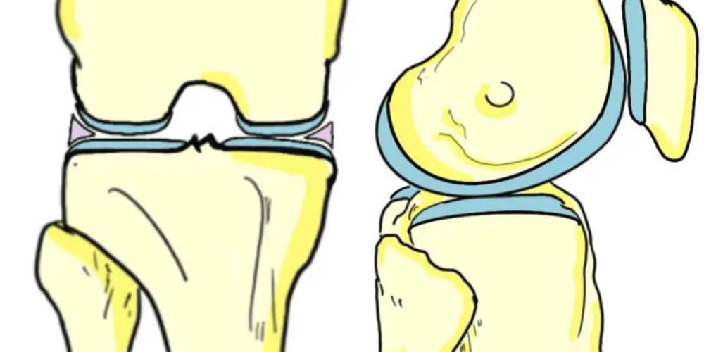 Артроз коленного сустава (гонартроз)