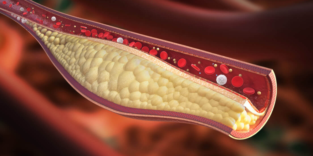 Атеросклероз