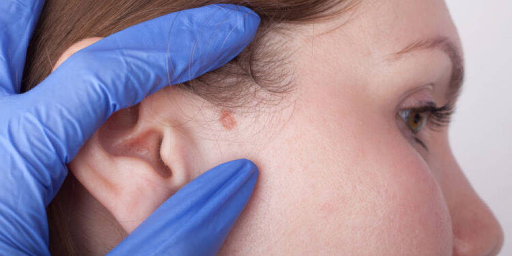 Базаліома (базальноклітинний рак шкіри)