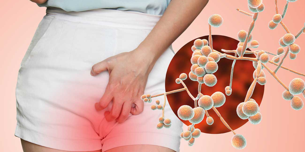 Вагинальный кандидоз (молочница)