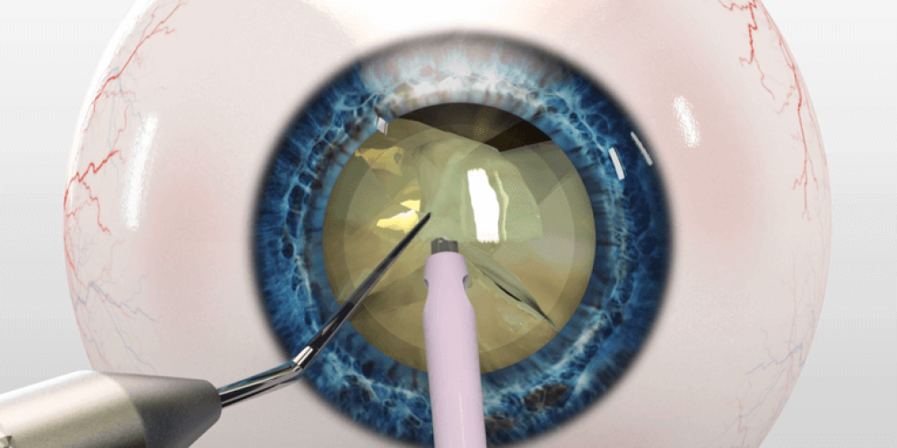 Лечение катаракты