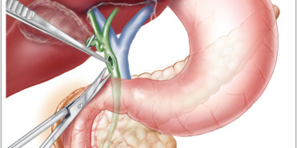 Холедохолітотомія