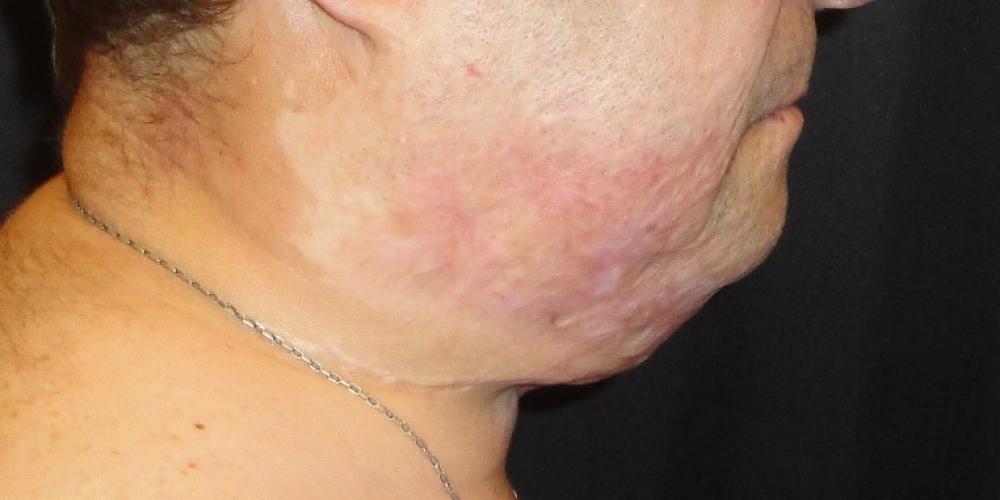 Пластика після опіків