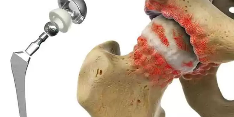 Эндопротезирование тазобедренного сустава (замена тазобедренного сустава) Эндопротезирование тазобедренного сустава (замена тазобедренного сустава)