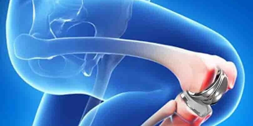 Стоит ли менять коленный сустав