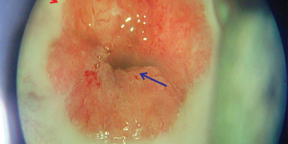 Эрозия шейки матки
