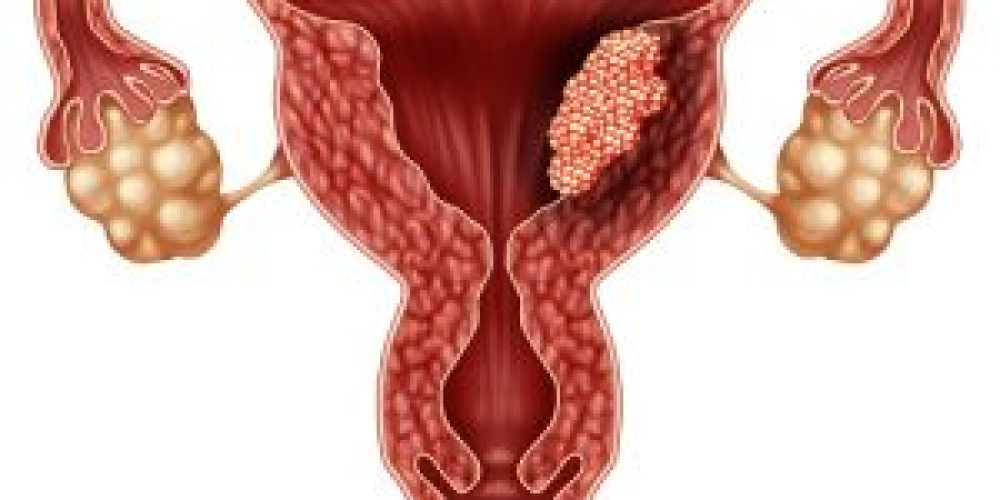 Лечение рака влагалища