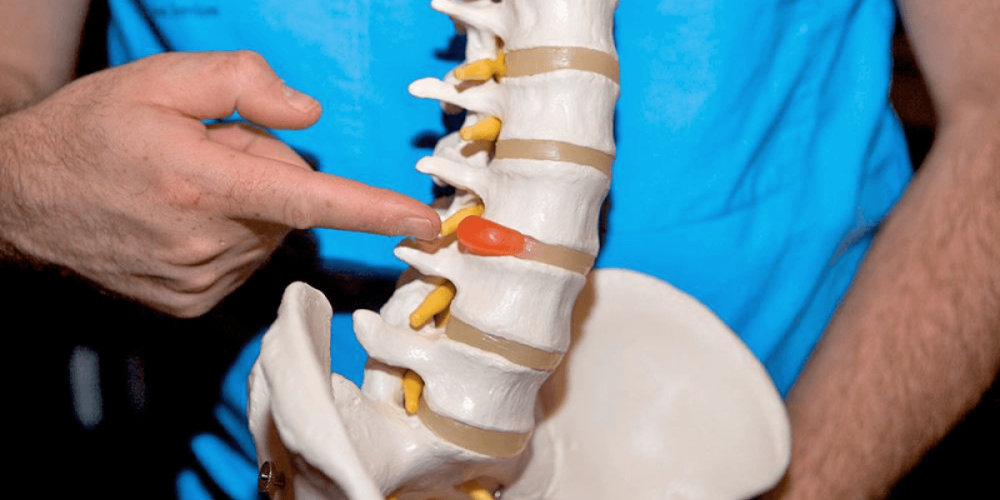 Міжхребцева грижа