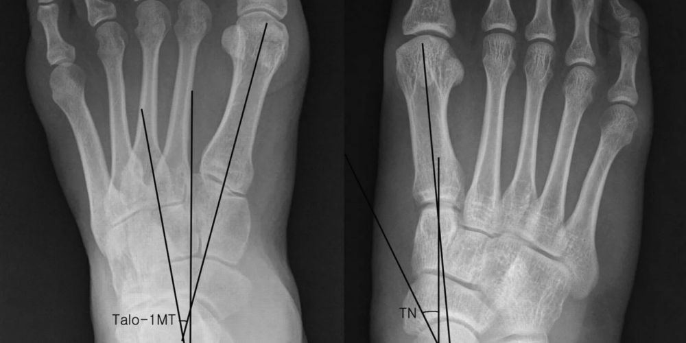 Вальгусная деформации стопы