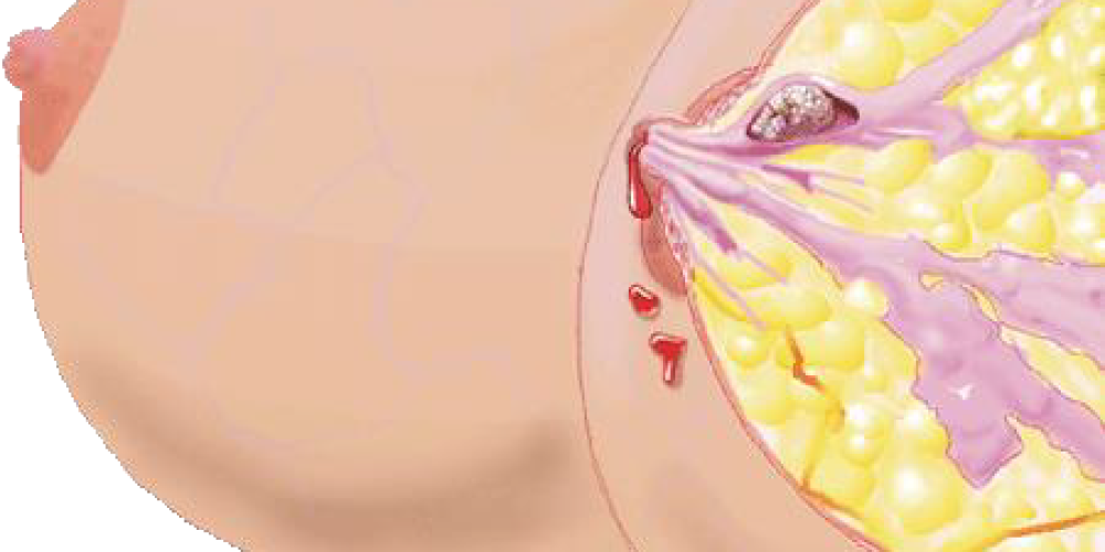 Внутрипротоковая папиллома молочной железы