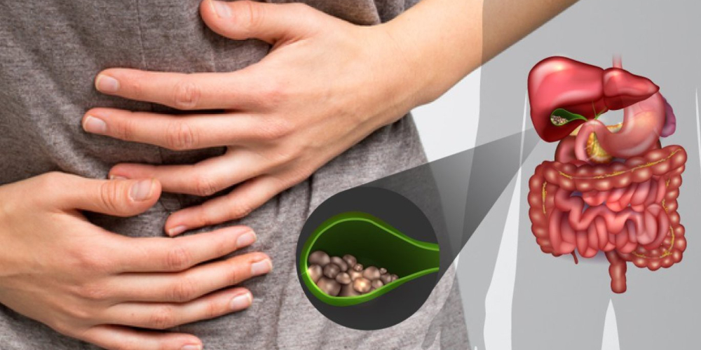 Желчекаменная болезнь (ЖКБ)