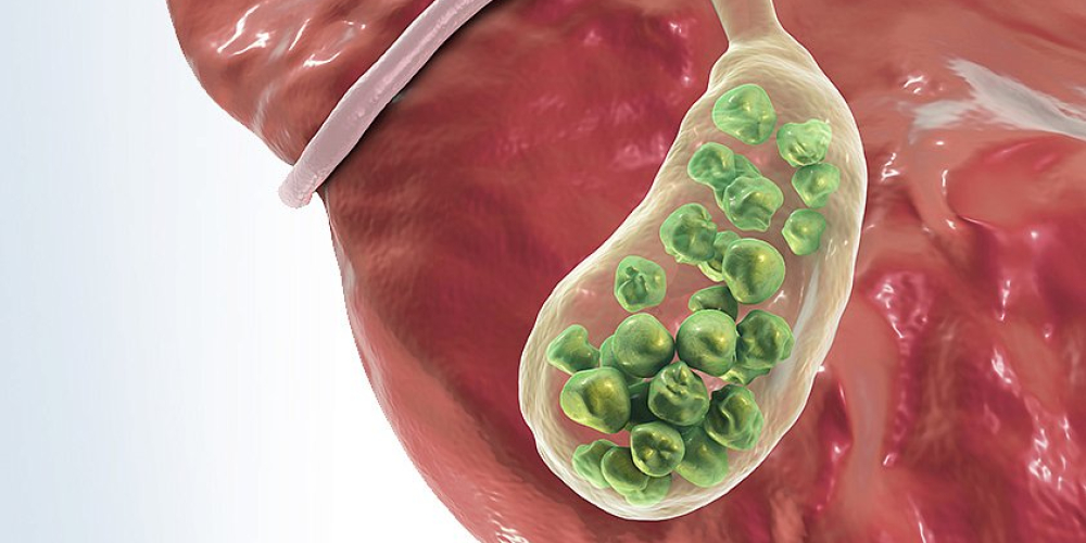 Хронический калькулезный холецистит