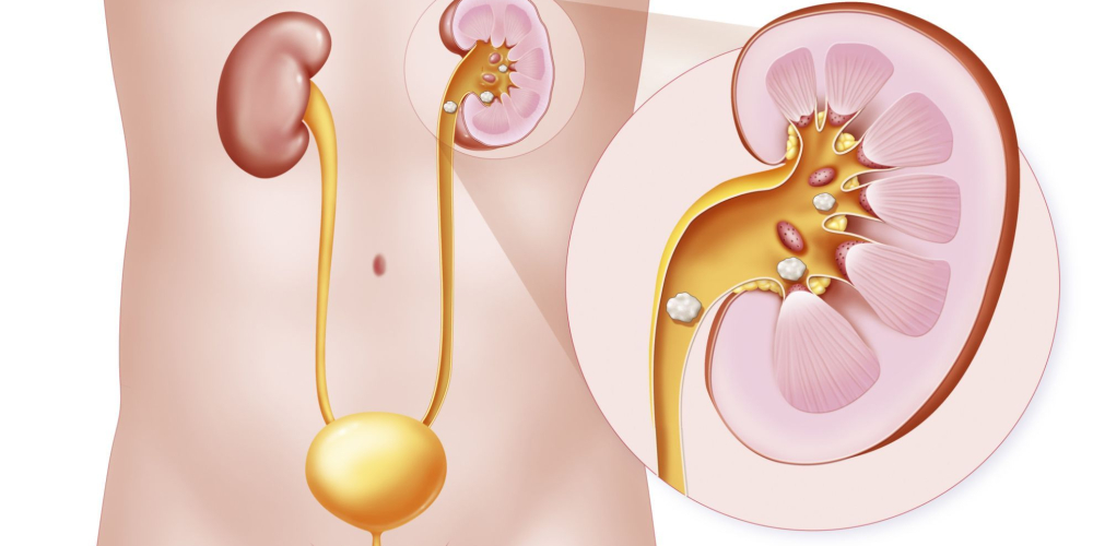 Камені в сечоводі