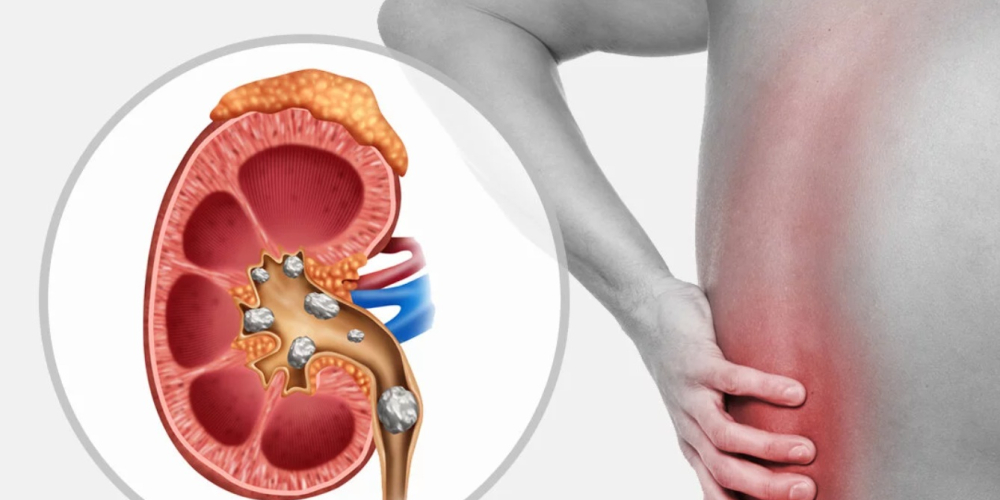 Камені в нирках Камені в нирках