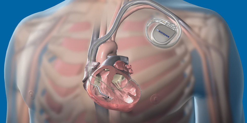 Установка кардиостимулятора