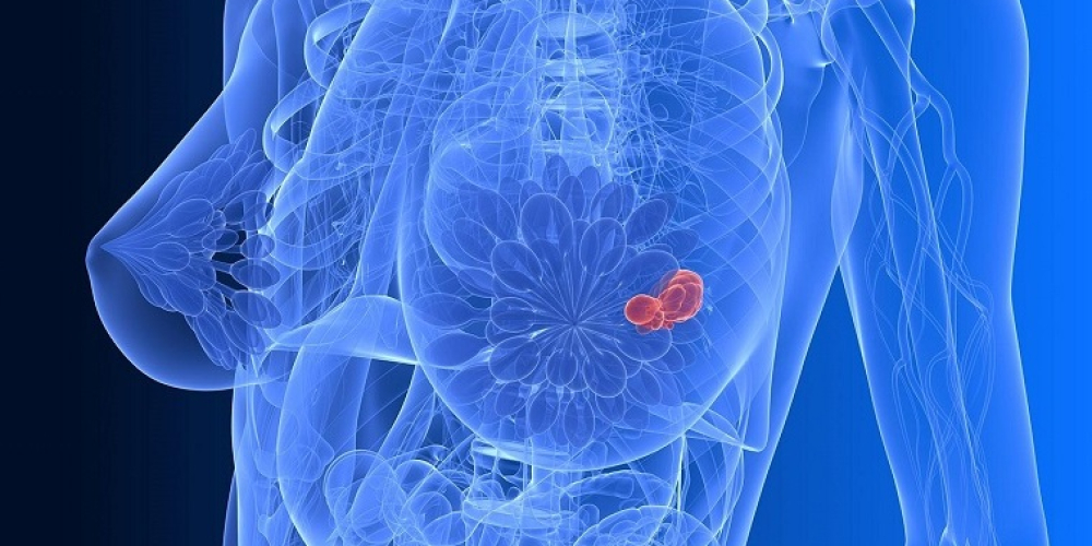 Киста молочной железы