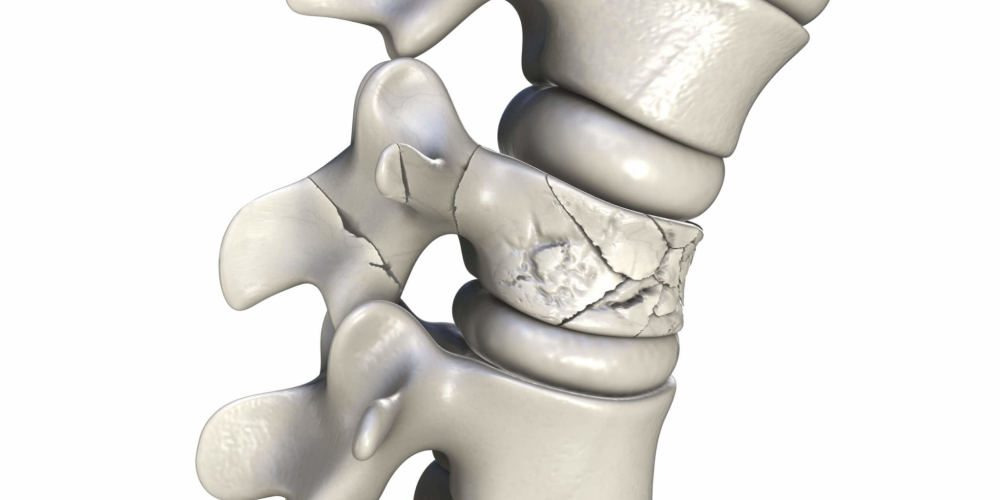 Компресійний перелом хребця