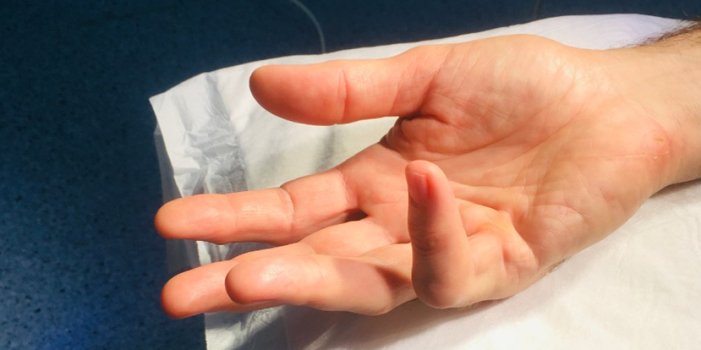 Контрактура Дюпюитрена Контрактура Дюпюитрена