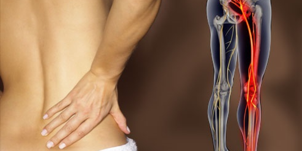 Радикулопатия (корешковый синдром)