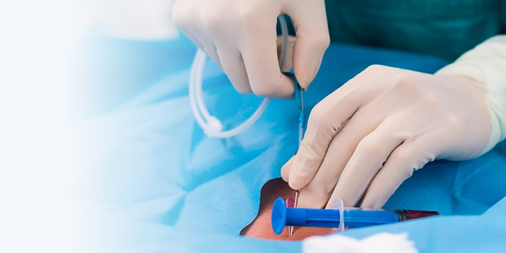 Коронарографія