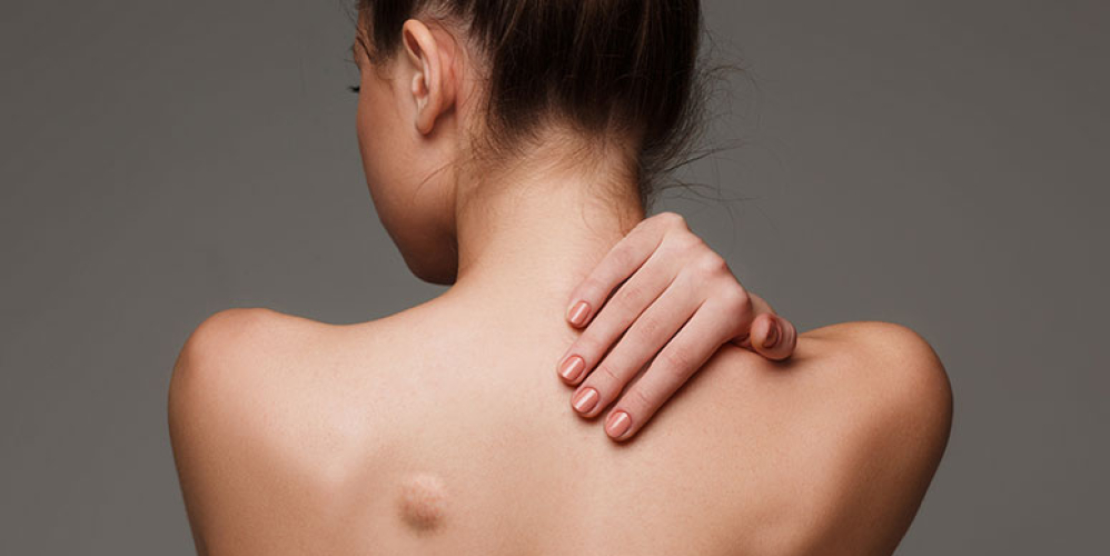 Ліпома (жировик)