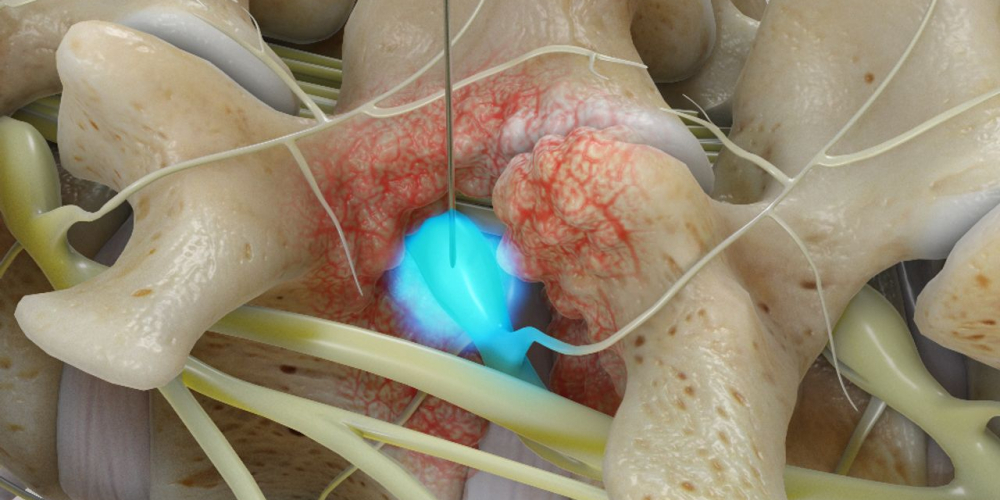 Селективные блокады нервных корешков