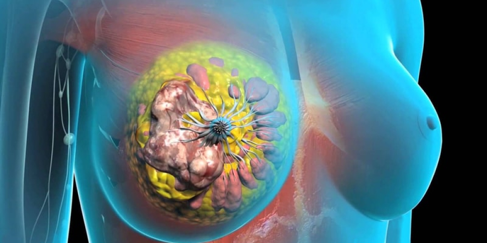 Фіброзно-кістозна мастопатія (ФКМ)