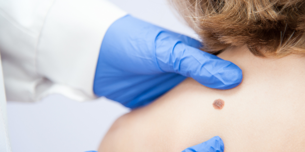 Меланома (меланобластома) Меланома (меланобластома)